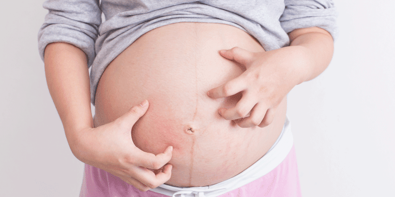 What is Cholestasis of Pregnancy?