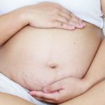How to Get Rid of Pregnancy Stretch Marks with Simple Steps & Safe Products