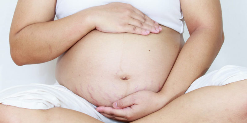 How to Treat Pregnancy Stretch Marks with Simple Steps & Safe Products