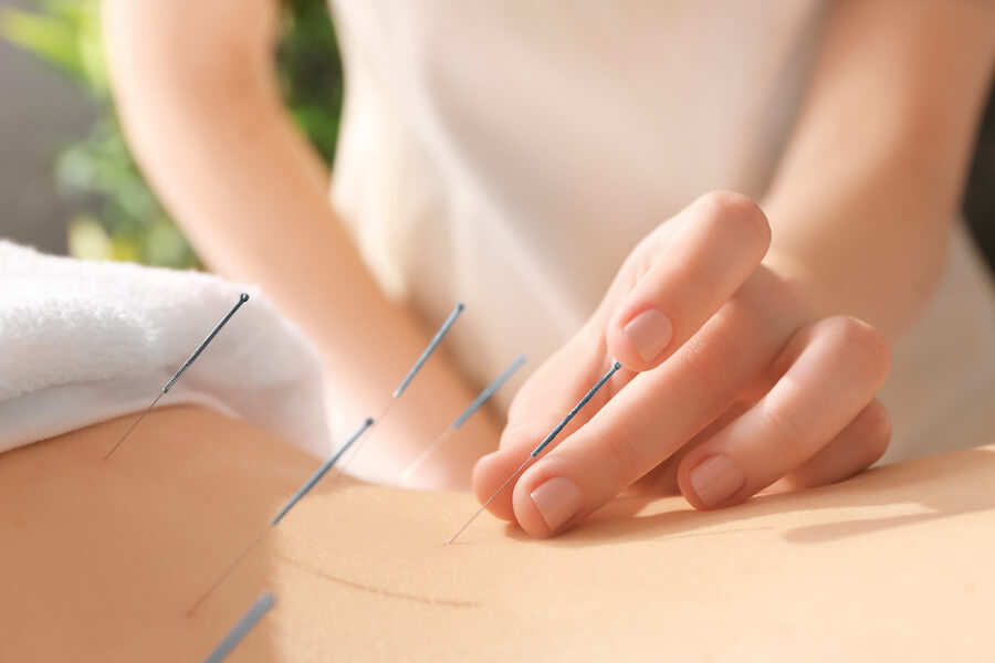 A photo of a woman getting acupuncture. 